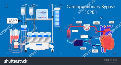 centrifugal pump system cardiopulmonary bypass|cardiopulmonary bypass machine diagram.